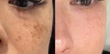 Laser Skin Resurfacing