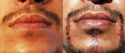 Beard / Moustache Transplantation