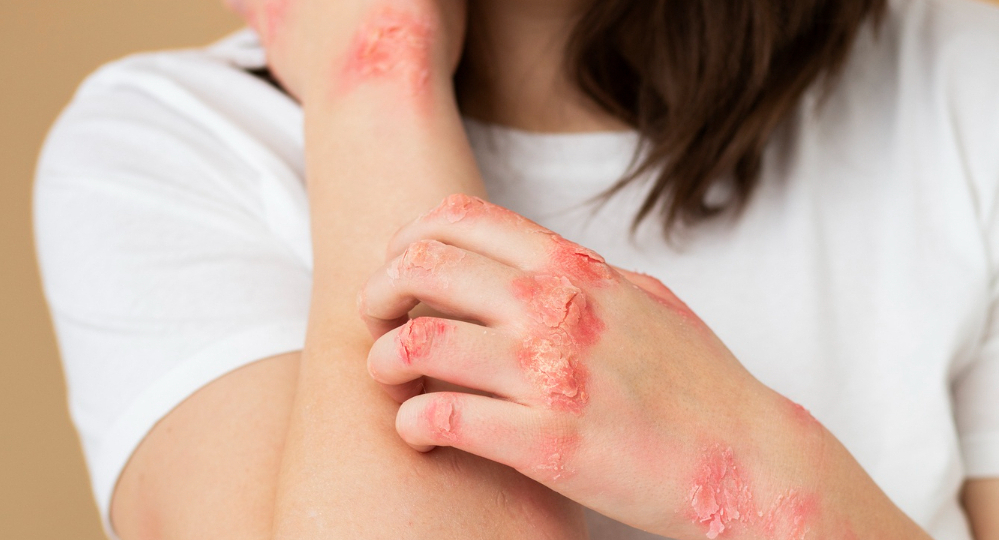 Eczema