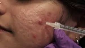 Intra-lesional Corticosteroid Injection