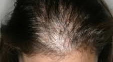 Hair-loss Treatment