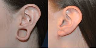 Ear Lobe Repair