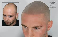 Scalp Micropigmentation