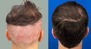 Follicular Unit Extraction (FUE) 