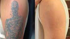 Laser Tattoo Removal 