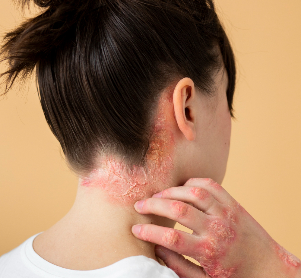 Psoriasis