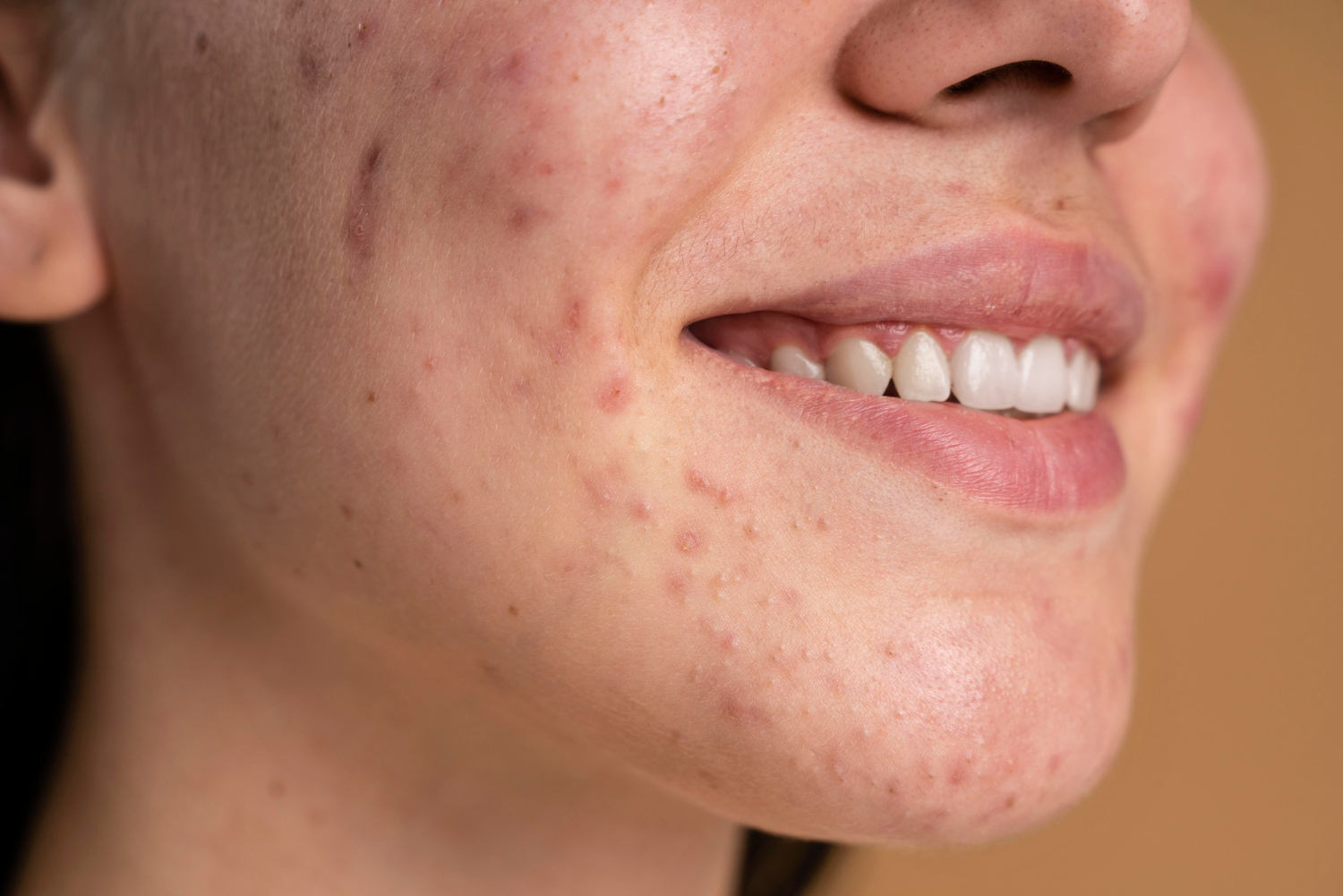 Acne Scars